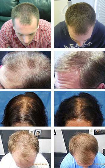 fda laser hair loss treatment for androgenetic alopecia scranton pennsylvania