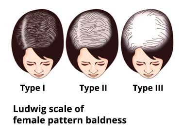 ludwig savin scale female pattern baldness
