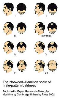 ludwig hamilton scale male pattern baldness